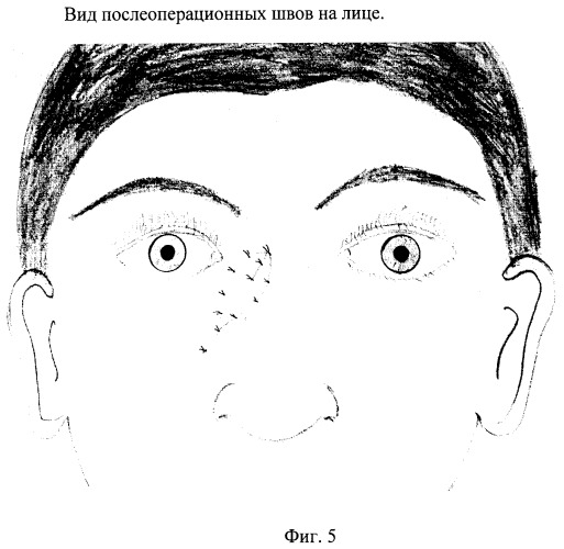 Способ пластики корня носа и медиального угла глаза (патент 2375000)