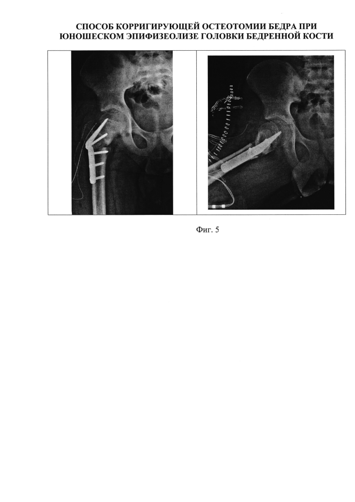Способ корригирующей остеотомии бедра при юношеском эпифизеолизе головки бедренной кости (патент 2604039)