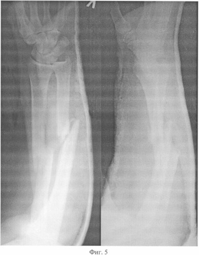 Способ чрескостного остеосинтеза диафизарных повреждений костей предплечья и аппарат для его осуществления (патент 2328242)