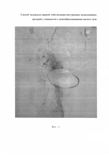 Способ эндоваскулярной эмболизации внутренних подвздошных артерий у пациенток с новообразованиями малого таза (патент 2576092)