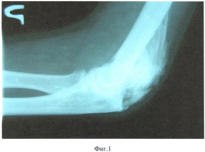 Способ оперативного лечения оссификатов локтевого сустава (патент 2356507)