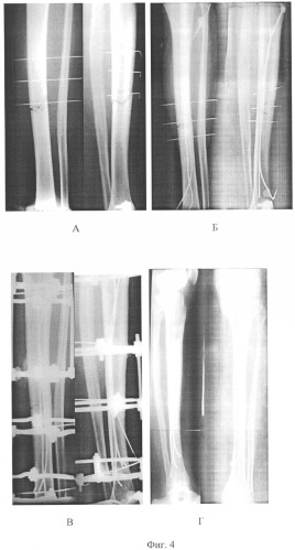 Способ лечения переломов длинных трубчатых костей (патент 2317034)