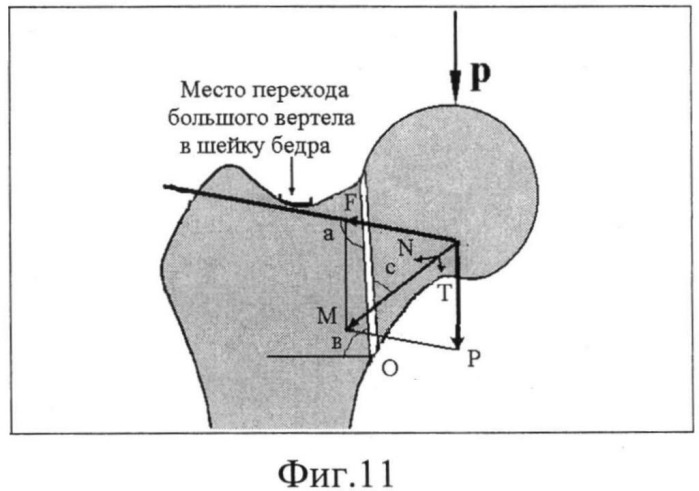 Шейка бедра карта вызова