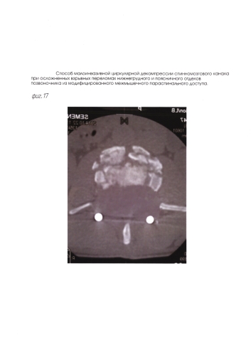 Способ малоинвазивной циркулярной декомпрессии спинномозгового канала при осложненных взрывных переломах нижнегрудного и поясничного отделов позвоночника из модифицированного межмышечного параспинального доступа (патент 2592779)