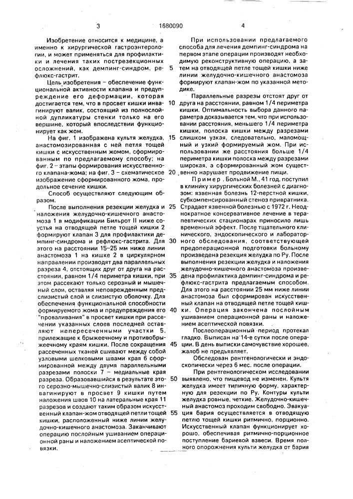 Способ формирования клапана тонкой кишки (патент 1680090)