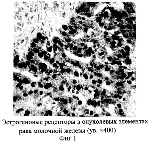 Способ прогнозирования течения заболевания раком молочной железы (патент 2300111)