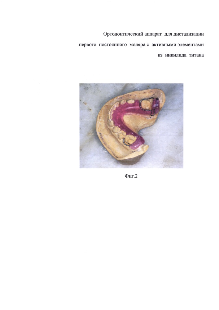 Способ изготовления ортодонтического аппарата и ортодонтический аппарат для дистализации первого постоянного моляра с активными элементами из никелид титана (патент 2635961)