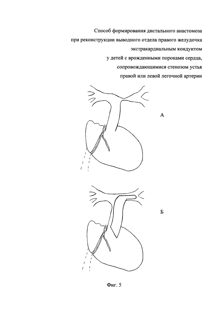 Способ формирования дистального анастомоза при реконструкции выводного отдела правого желудочка экстракардиальным кондуитом у детей с врожденными пороками сердца, сопровождающимися стенозом устья правой или левой легочной артерии (патент 2647226)