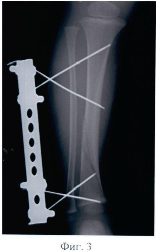 Способ оперативного лечения изолированного перелома большеберцовой кости у детей (патент 2407476)