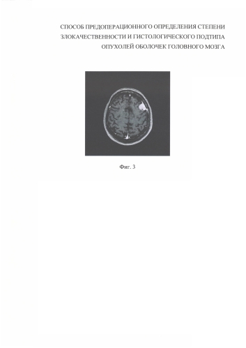 Способ предоперационного определения степени злокачественности и гистологического подтипа опухолей оболочек головного мозга (патент 2589652)