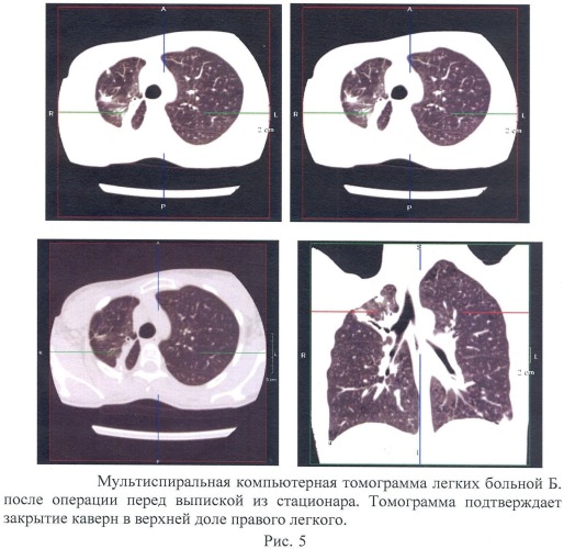 Способ лечения деструктивного туберкулеза легких (патент 2475192)