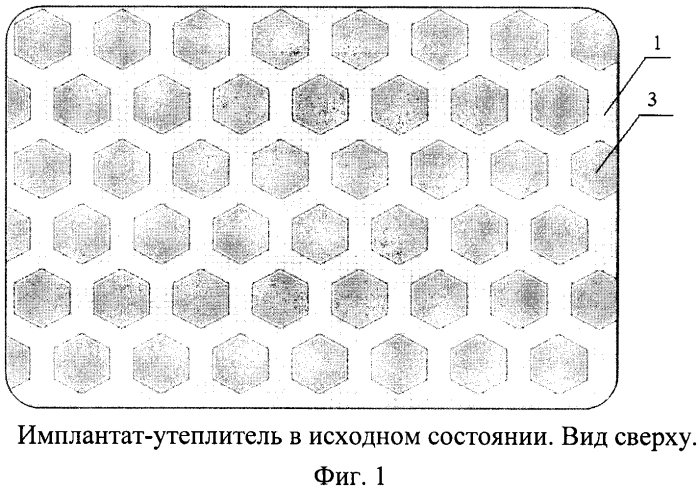 Краниальный имплантат-утеплитель (патент 2579744)