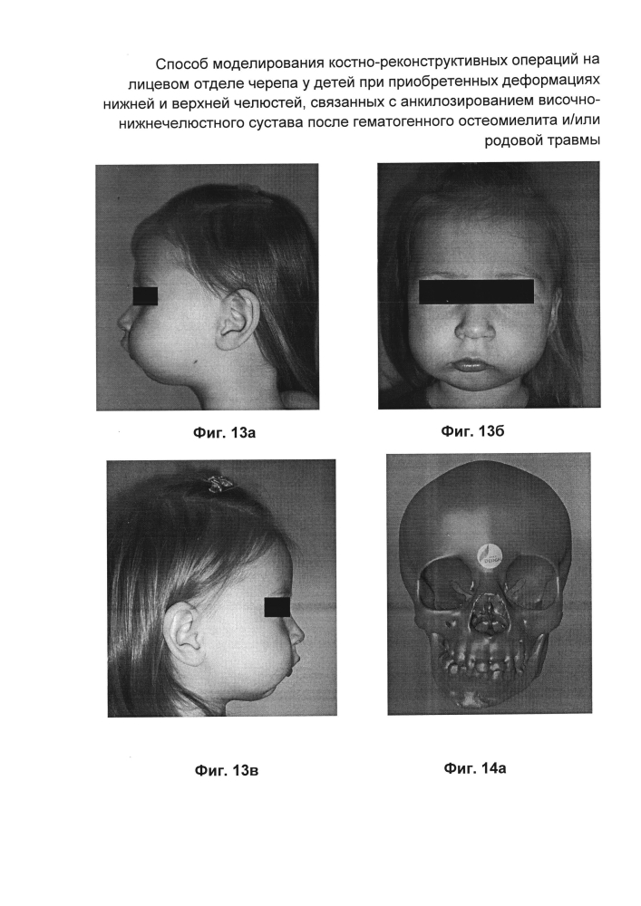 Способ моделирования костно-реконструктивных операций на лицевом отделе черепа у детей при приобретенных деформациях нижней и верхней челюстей, связанных с анкилозированием височно-нижнечелюстного сустава после гематогенного остеомиелита и/или родовой травмы (патент 2604774)