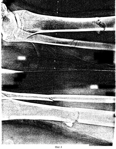 Гипсовая фиксация переломов голени при замедленной консолидации (патент 2325881)