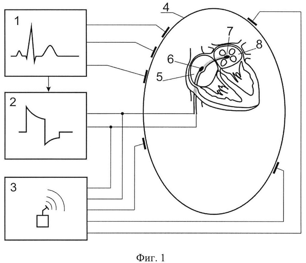 Способ формирования импульсного электрического поля для безболевой эндокардиальной кардиоверсии (патент 2609276)
