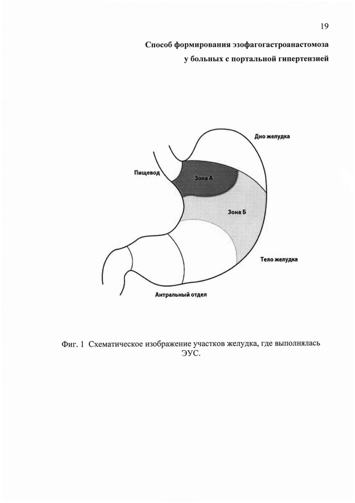 Способ формирования эзофагогастроанастомоза у больных с портальной гипертензией (патент 2607178)