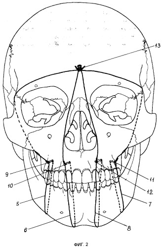Способ иммобилизации отломков при переломах челюстей (патент 2269318)