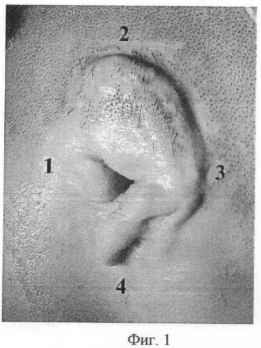 Способ определения кожной микроциркуляции в околоушной области у больных с врожденными пороками уха и приобретенными деформациями ушной раковины (патент 2462994)