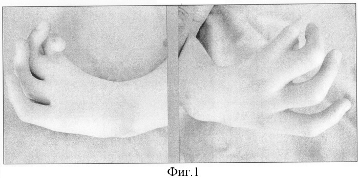 Способ восстановления функции кисти при сочетании врожденной гипоплазии и аплазии первого пальца кисти с лучевой косорукостью (патент 2300333)