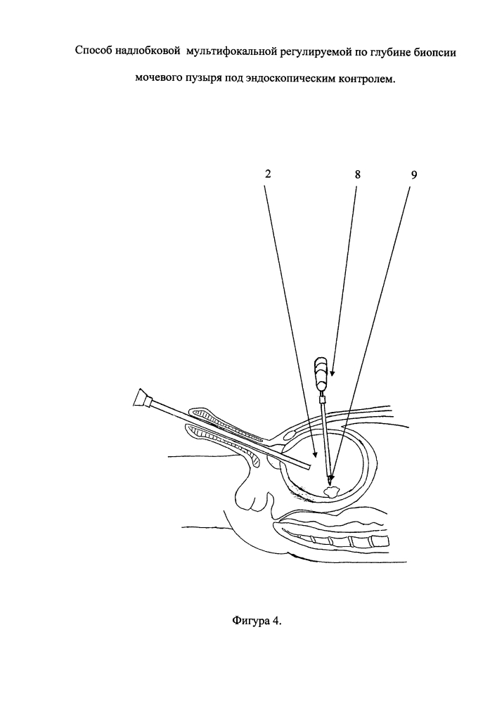 Способ надлобковой мультифокальной регулируемой по глубине биопсии мочевого пузыря под эндоскопическим контролем (патент 2641838)