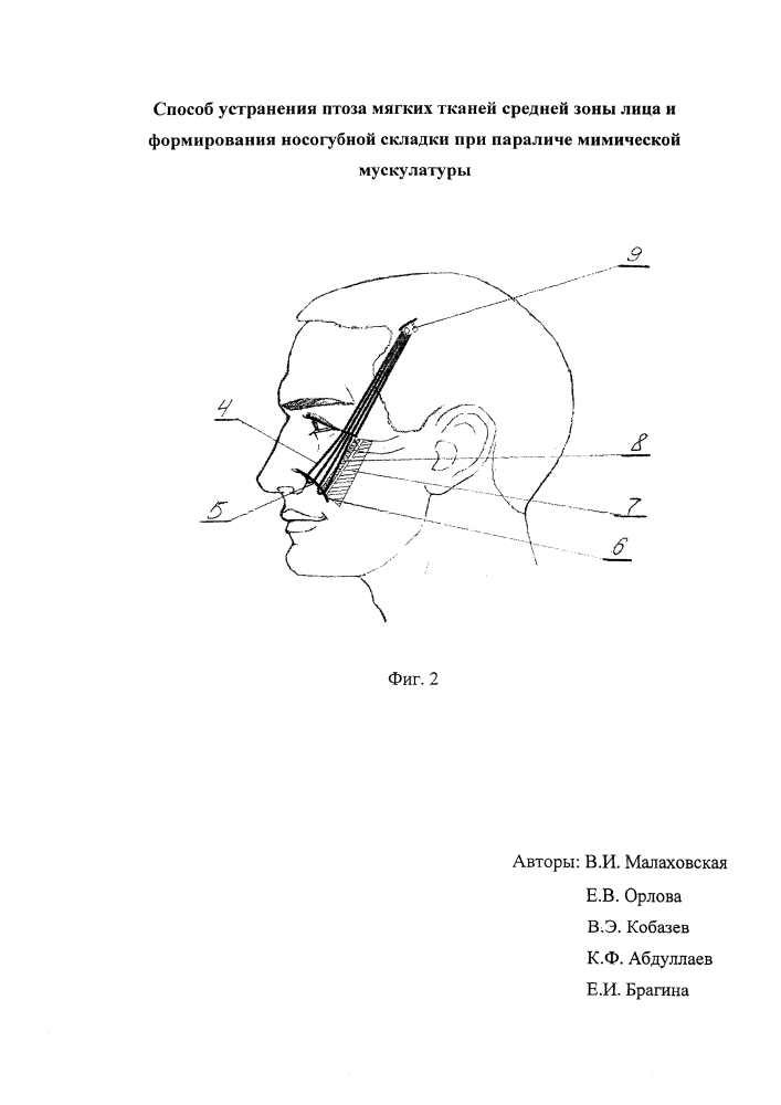 Способ устранения птоза мягких тканей средней зоны лица и формирования носогубной складки при параличе мимической мускулатуры (патент 2639811)