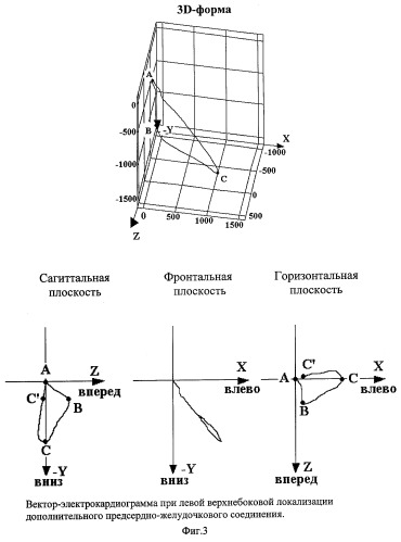 Способ локализации дополнительных проводящих путей при синдроме вольфа-паркинсона-уайта с помощью вектор-электрокардиографии (патент 2268640)