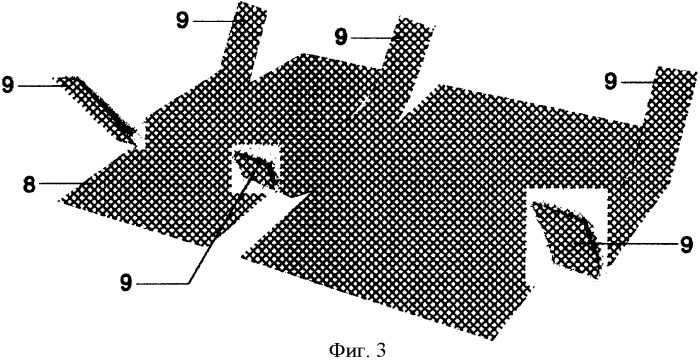 Способ фиксации эндопротеза при выполнении атензионной пластики передней брюшной стенки (патент 2365342)
