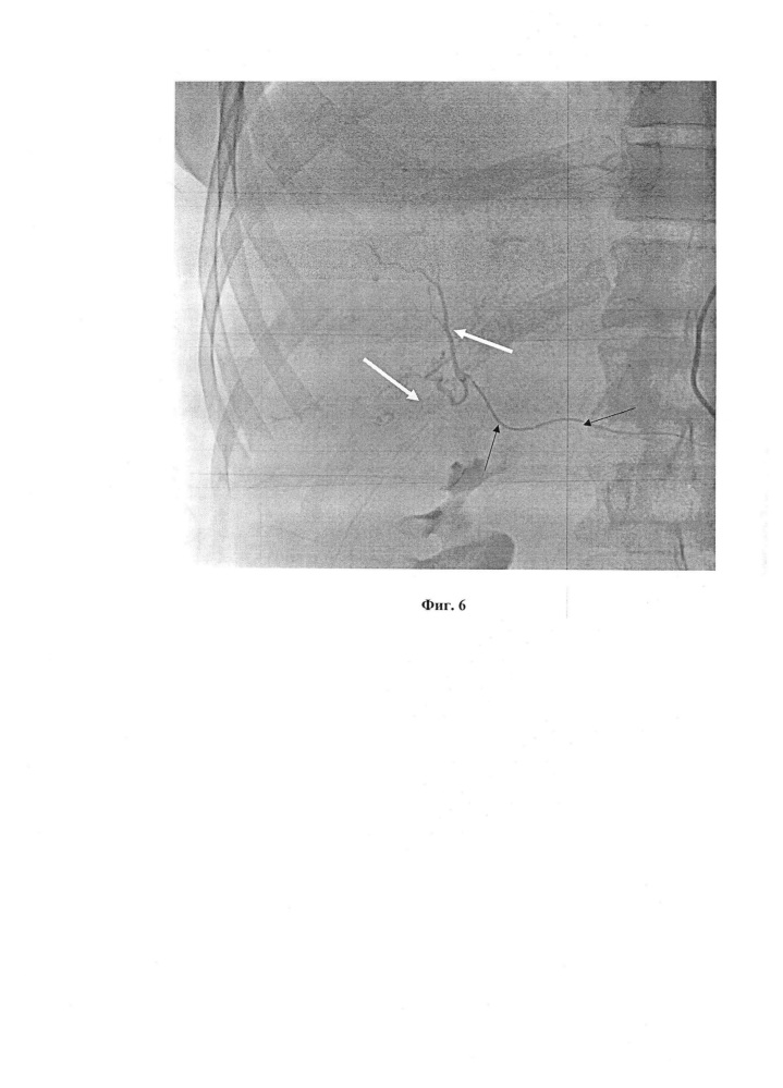 Способ рентгенэндоваскулярной эмболизации висцеральных ветвей через артерии верхних конечностей при помощи катетера headhunter при различных патологиях желудочно-кишечного тракта (патент 2652743)