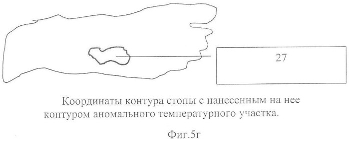 Способ оценки эффективности ортопедической коррекции стопы (патент 2357705)