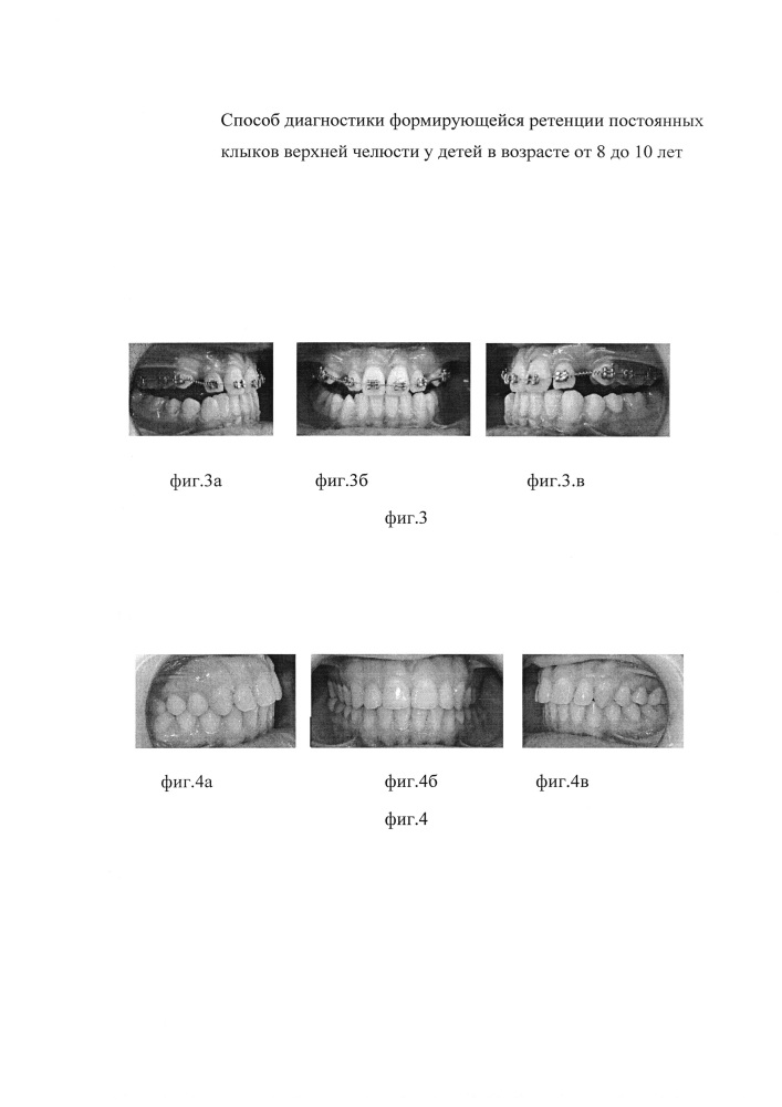 Способ диагностики формирующейся ретенции постоянных клыков верхней челюсти у детей в возрасте от 8 до 10 лет (патент 2629329)