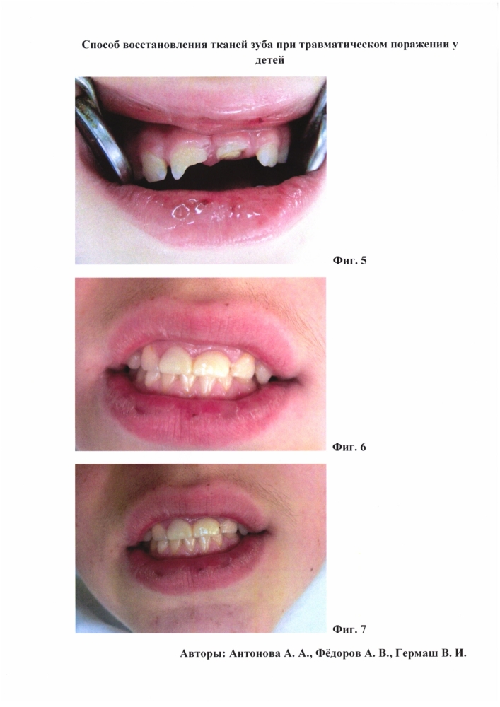 Способ восстановления тканей зуба при травматическом поражении у детей (патент 2604387)