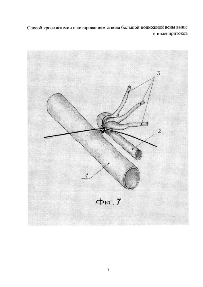 Способ кроссэктомии с лигированием ствола большой подкожной вены выше и ниже притоков (патент 2607919)