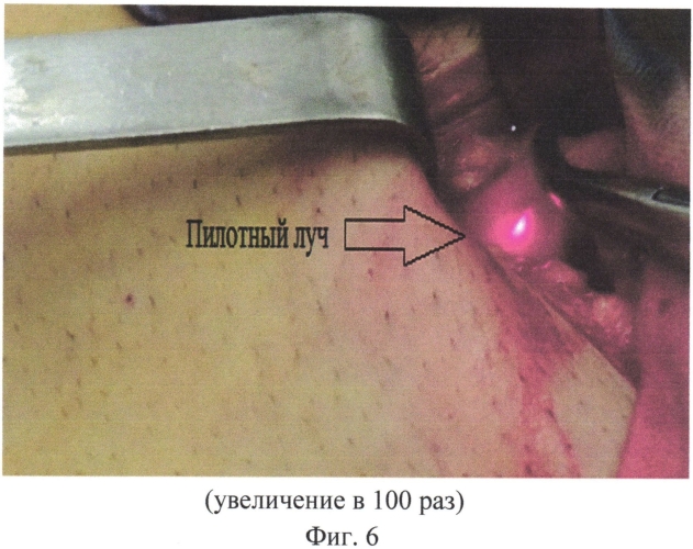 Способ эндоваскулярной лазерной коагуляции большой подкожной вены с варикозной трансформацией (патент 2554379)