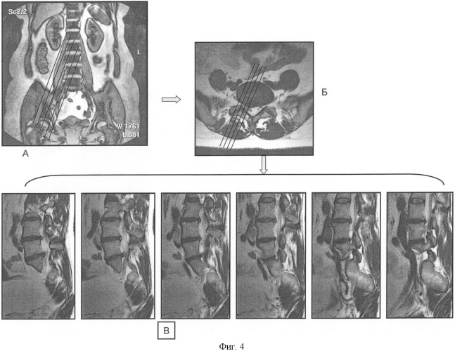 Способ выявления остеохондроза пояснично-крестцового отдела позвоночника (патент 2382603)