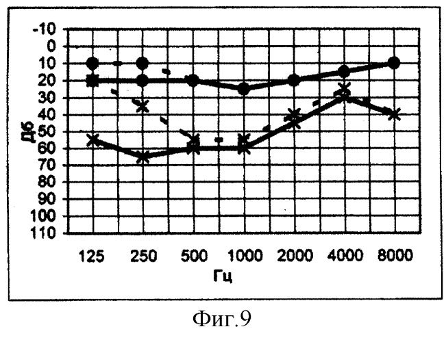 Способ лечения болезни меньера (патент 2251390)