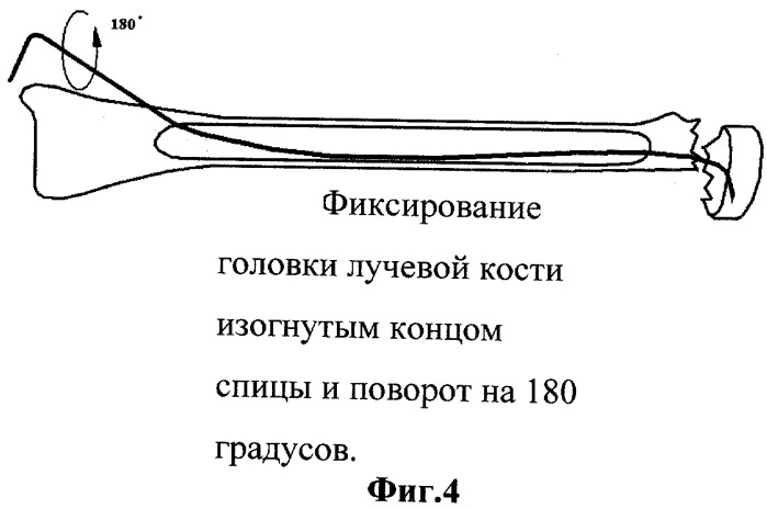 Способ лечения переломов шейки лучевой кости (патент 2342092)