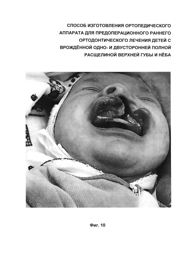 Способ изготовления ортопедического аппарата для предоперационного раннего ортодонтического лечения детей с врождённой одно- и двусторонней полной расщелиной верхней губы и нёба (патент 2599373)
