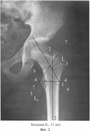Способ определения антеторсии шейки бедренной кости (патент 2350268)