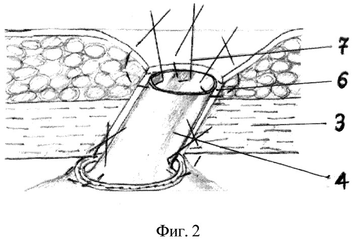 Способ формирования эпицистокутанеостомы (патент 2294161)