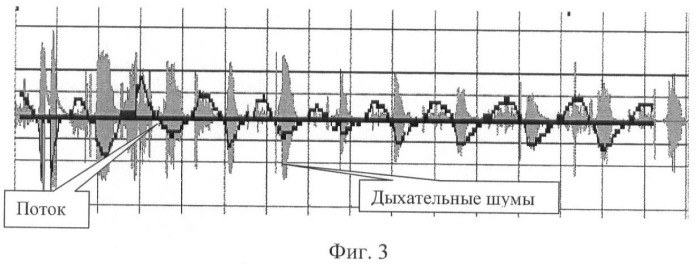 Способ фильтрации дыхательных шумов на основе задержки дыхания (патент 2415643)