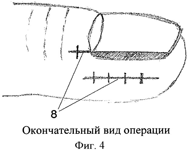 Способ операции при вросшем ногте первого пальца стопы (патент 2460471)
