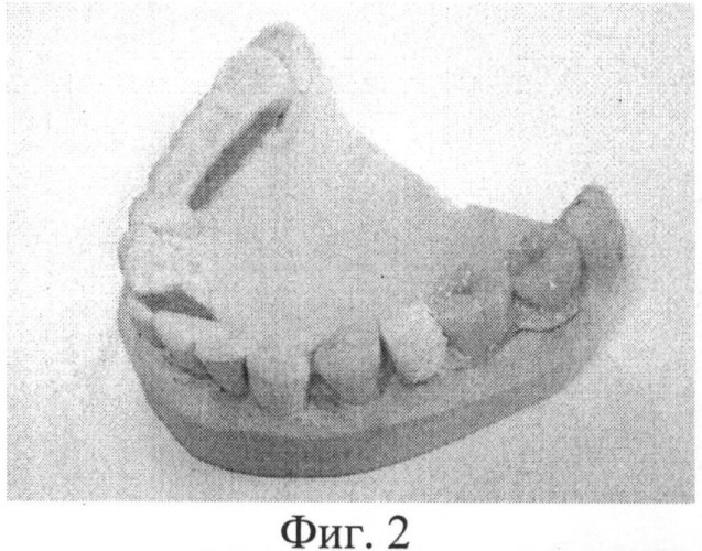 Способ изготовления иммедиат-протеза для лиц с ограниченной мобильностью (патент 2486877)
