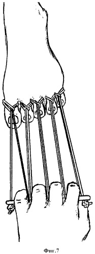 Устройство для вправления вывихов переднего отдела стопы (патент 2372881)