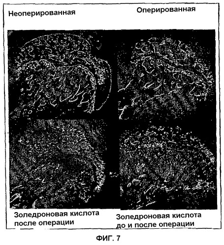 Лекарственное средство для лечения остеонекроза и для лечения пациентов с риском развития остеонекроза (патент 2284821)