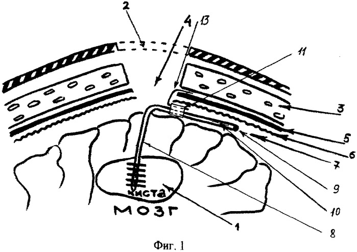Способ дренирования внутримозговых изолированных ликворных кист (патент 2279295)