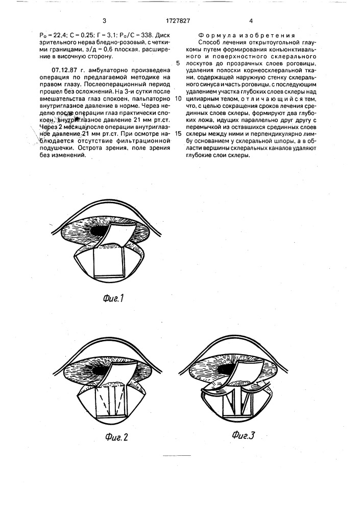 Способ лечения открытоугольной глаукомы (патент 1727827)