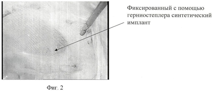 Способ комбинированной лапароскопической герниопластики (патент 2435528)