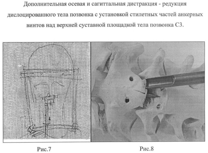 Способ анкерной коррекции и фиксации травматических дислокаций тела позвонка с2 при переломах палача (патент 2463978)