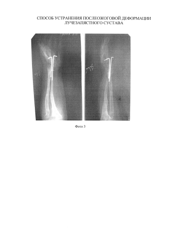 Способ устранения послеожоговой локтевой косорукости (патент 2578849)