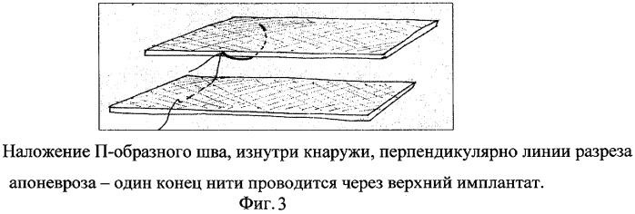 Способ ушивания апоневроза (патент 2277384)